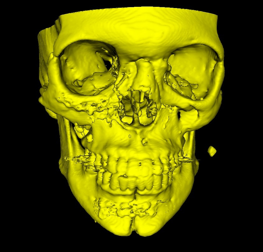 ../_images/segmentation_manual_noise_amalgam_3d.jpg