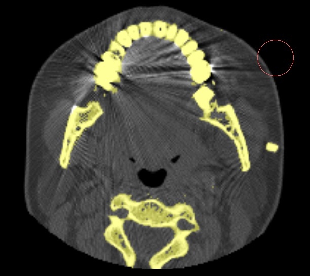 ../_images/segmentation_manual_noise_amalgam_removed.jpg