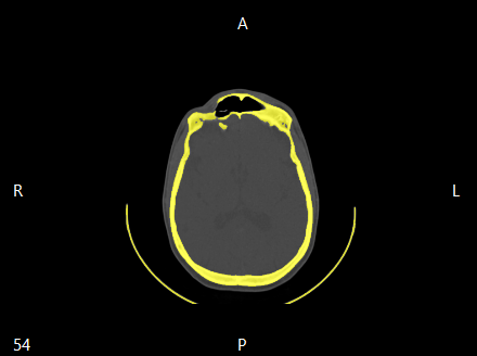 ../_images/segmentation_threshold_axial_en.png