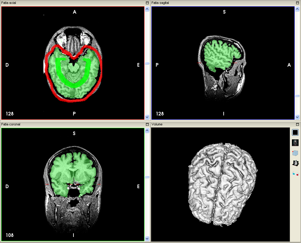 ../_images/segmentation_watershed_multiplanar_3d_pt.png