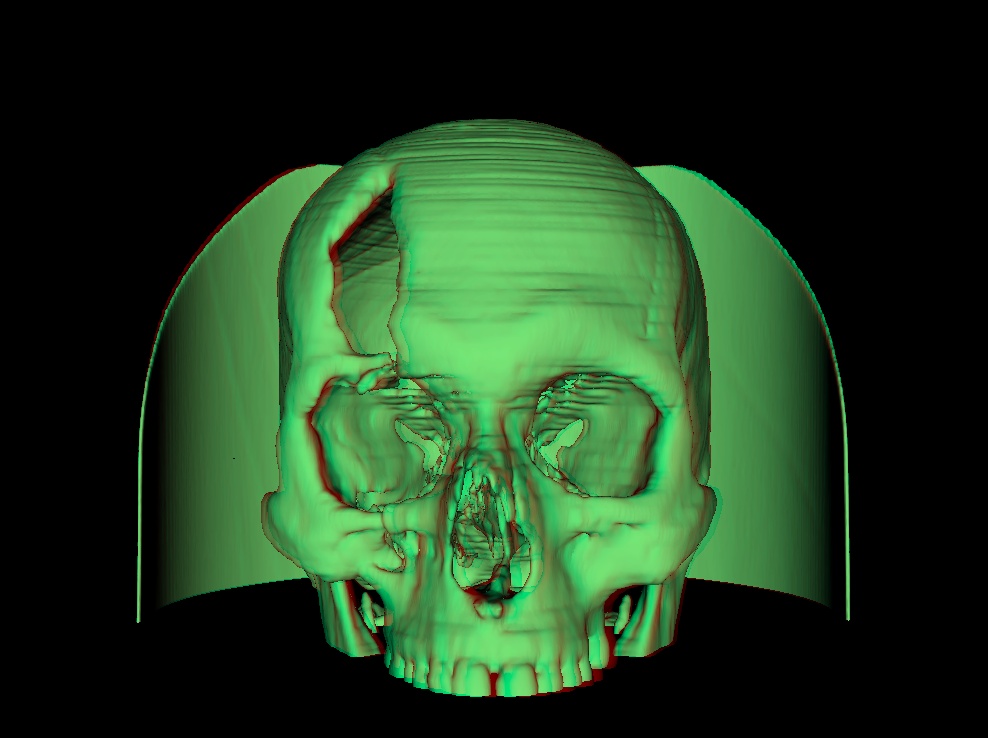 ../_images/st_surf_anaglyph.jpg